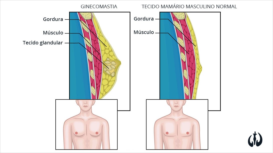ginecomastia-o-que-e
