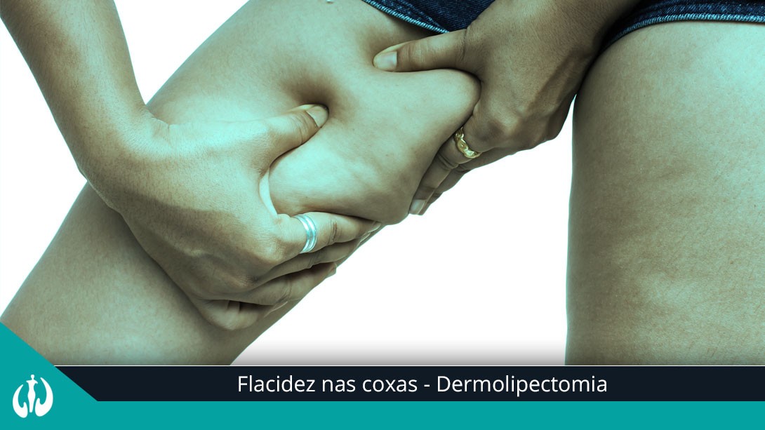 Flacidez nas coxas pode ser resolvida com dermolipectomia