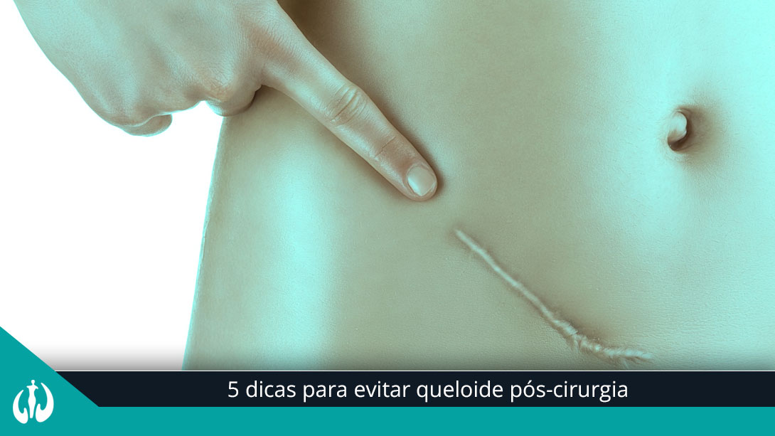 5 dicas para evitar queloide pós-cirurgia