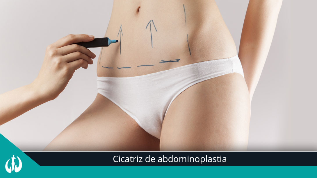 Cicatriz de Abdominoplastia