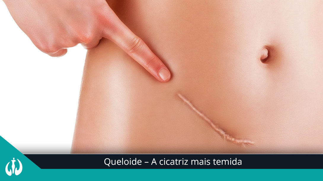 Queloide – A cicatriz mais temida