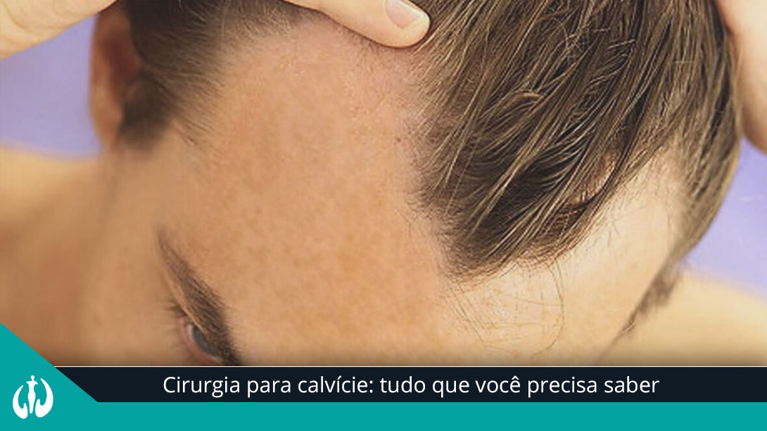 Cirurgia para calvície: tudo que você precisa saber