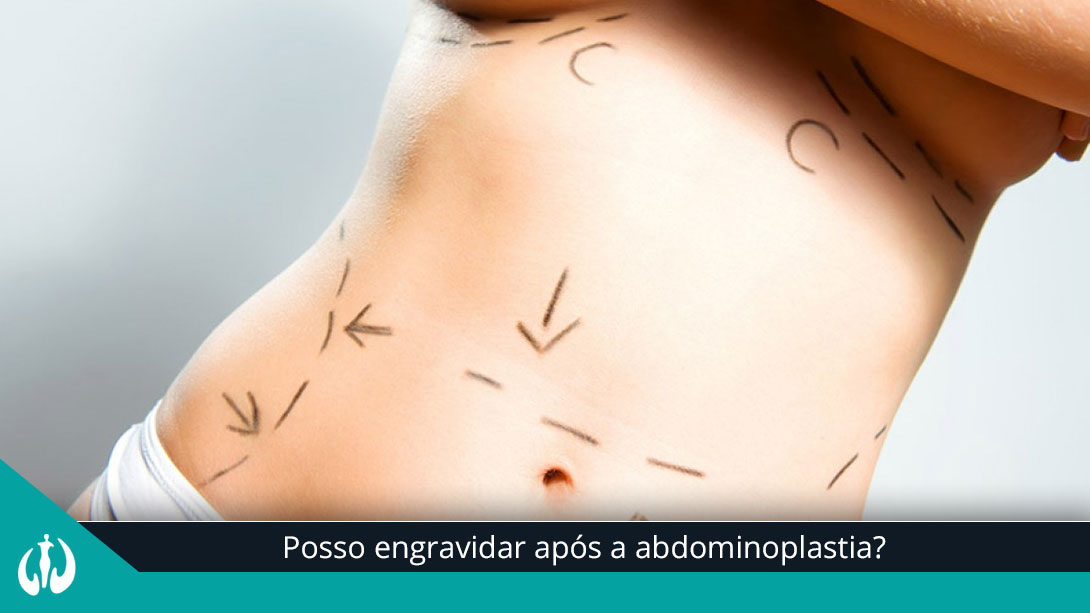Posso engravidar após a abdominoplastia?