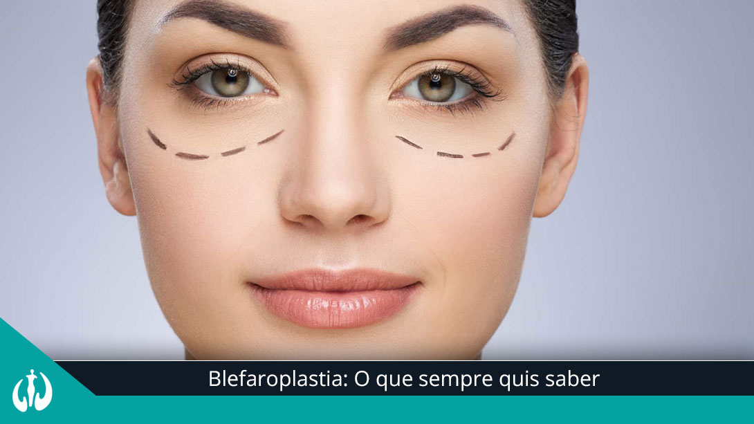 Blefaroplastia: O que sempre quis saber