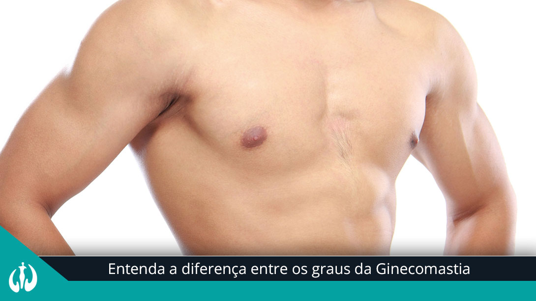 Entenda a diferença entre os graus da Ginecomastia