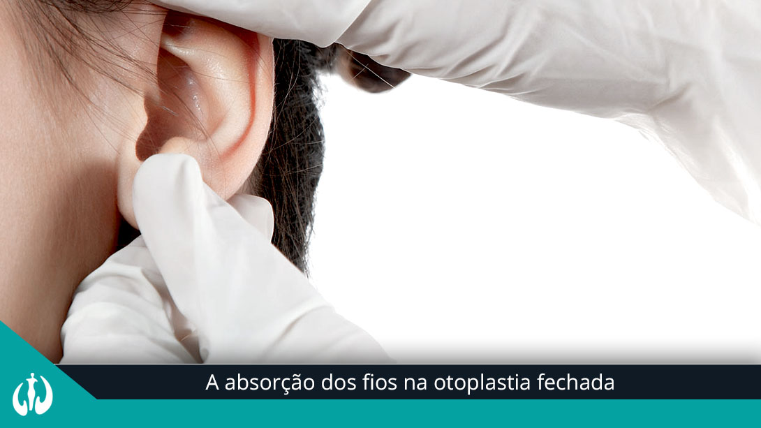 A absorção dos fios na otoplastia fechada