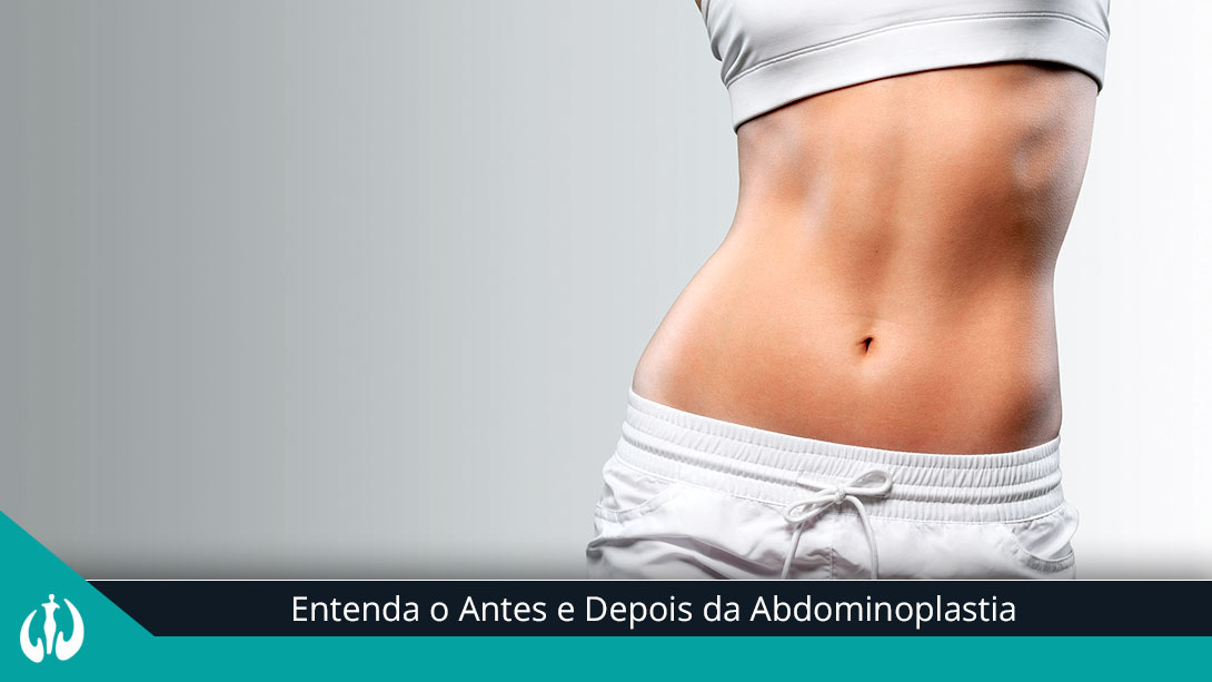 Entenda o Antes e Depois da Abdominoplastia