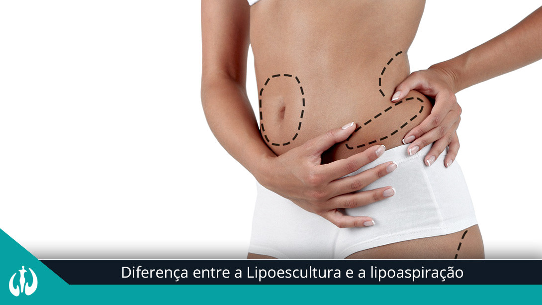Diferença entre a Lipoescultura e a lipoaspiração