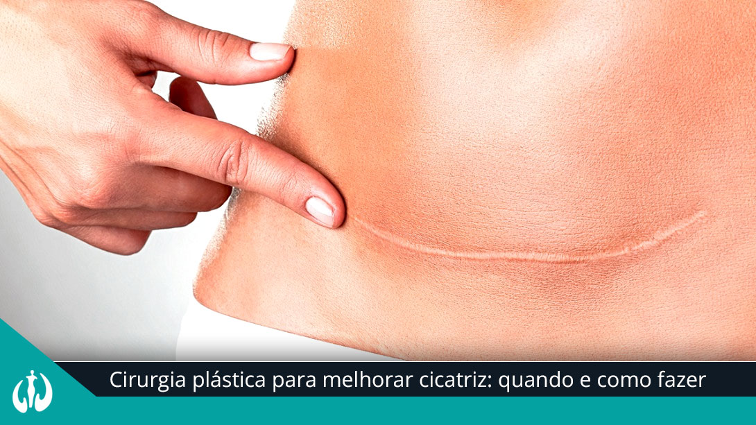 Cirurgia plástica para melhorar cicatriz: quando e como fazer