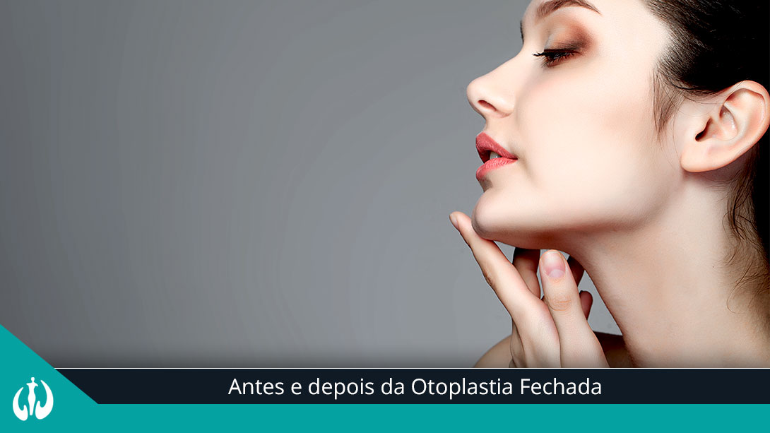 Antes e depois da Otoplastia Fechada