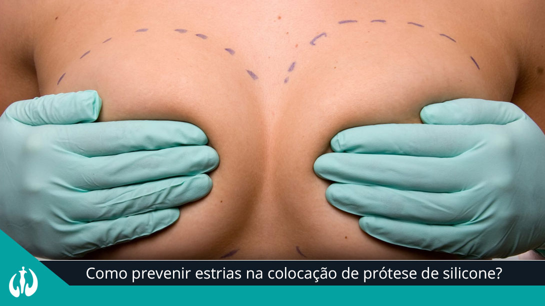 Como prevenir estrias na colocação de prótese de silicone?